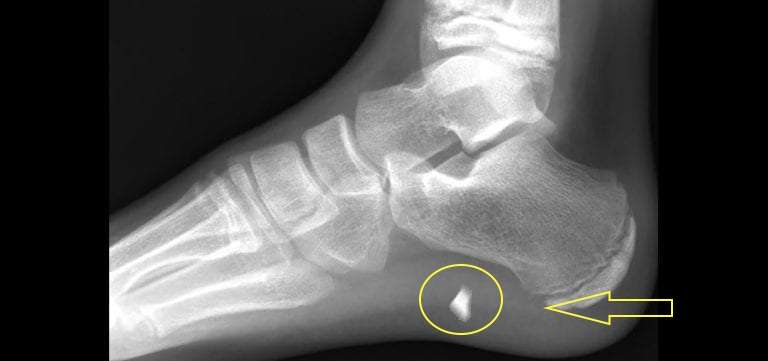 A digital X-ray of a human foot seen side on with a foreign object visible just forward of the heel and deeply in bedded in the soft tissue of the foot’s sole.